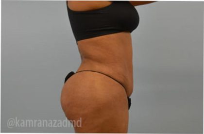 Liposuction Before & After Patient #2885