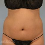Liposuction Before & After Patient #2886