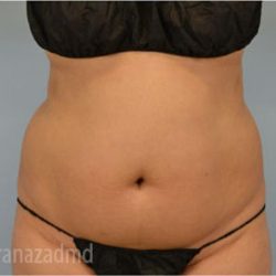 Liposuction Before & After Patient #2886