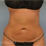 Liposuction Before & After Patient #2886