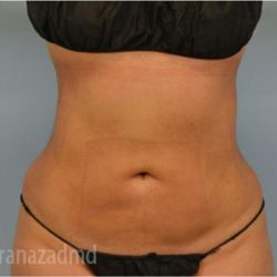 Liposuction Before & After Patient #2886