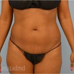 Liposuction Before & After Patient #2887