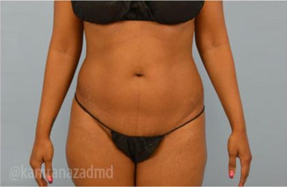 Liposuction Before & After Patient #2887