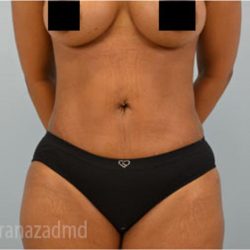Liposuction Before & After Patient #2887