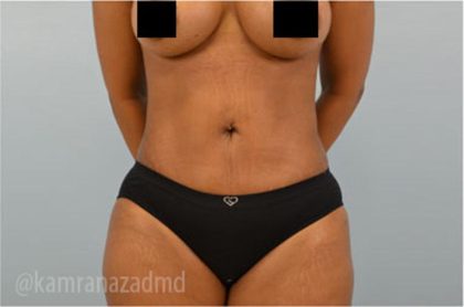 Liposuction Before & After Patient #2887