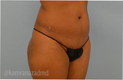 Liposuction Before & After Patient #2887