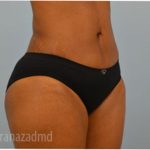 Liposuction Before & After Patient #2887
