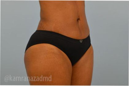Liposuction Before & After Patient #2887