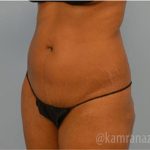 Liposuction Before & After Patient #2887