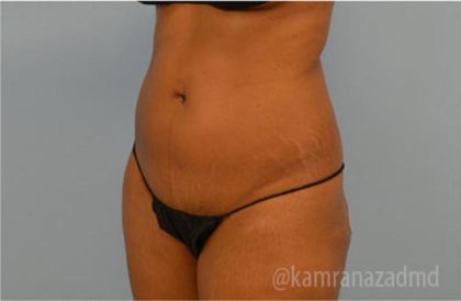 Liposuction Before & After Patient #2887