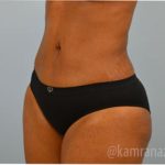 Liposuction Before & After Patient #2887