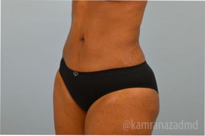 Liposuction Before & After Patient #2887