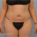 Liposuction Before & After Patient #2888