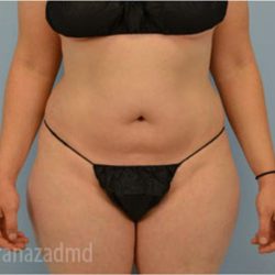 Liposuction Before & After Patient #2888
