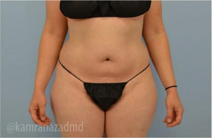 Liposuction Before & After Patient #2888