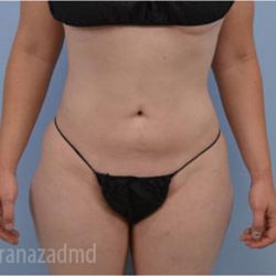 Liposuction Before & After Patient #2888