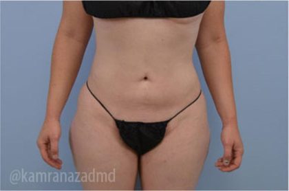Liposuction Before & After Patient #2888