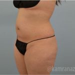Liposuction Before & After Patient #2888