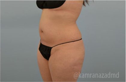 Liposuction Before & After Patient #2888