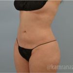 Liposuction Before & After Patient #2888