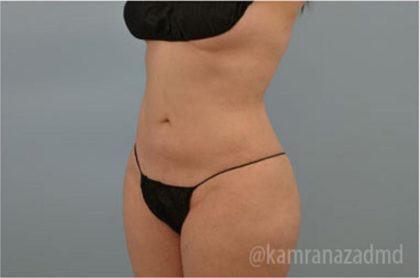 Liposuction Before & After Patient #2888