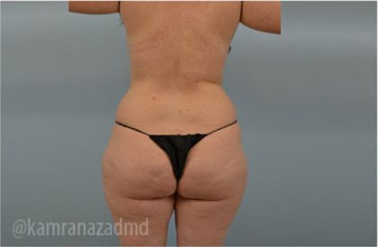 Liposuction Before & After Patient #2888