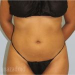Liposuction Before & After Patient #2889