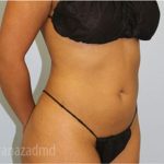 Liposuction Before & After Patient #2889