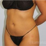 Liposuction Before & After Patient #2889