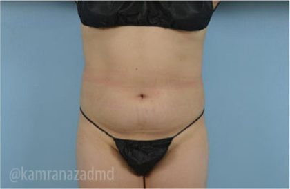 Liposuction Before & After Patient #2890
