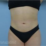 Liposuction Before & After Patient #2890