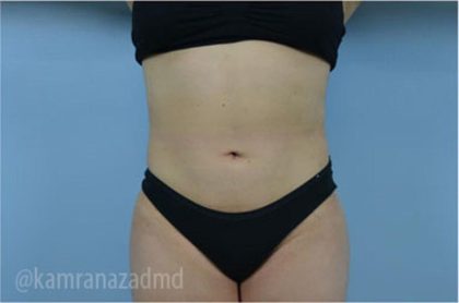 Liposuction Before & After Patient #2890