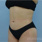 Liposuction Before & After Patient #2890