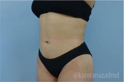 Liposuction Before & After Patient #2890