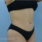 Liposuction Before & After Patient #2890
