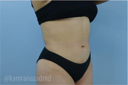 Liposuction Before & After Patient #2890
