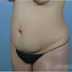 Liposuction Before & After Patient #2872