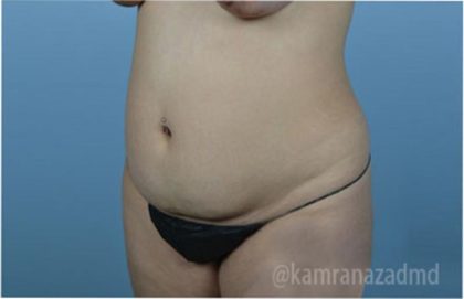 Liposuction Before & After Patient #2872