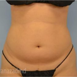 Liposuction Before & After Patient #2891