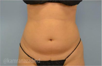 Liposuction Before & After Patient #2891