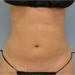 Liposuction Before & After Patient #2891