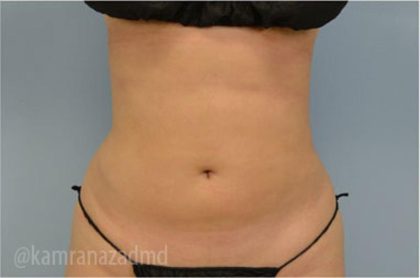 Liposuction Before & After Patient #2891