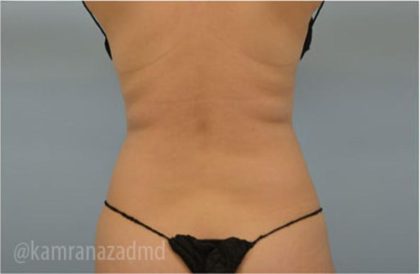 Liposuction Before & After Patient #2891