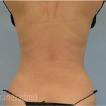Liposuction Before & After Patient #2891