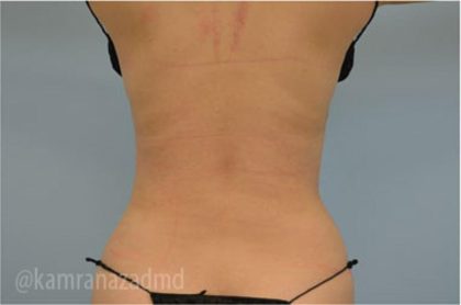Liposuction Before & After Patient #2891