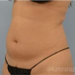 Liposuction Before & After Patient #2891