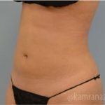 Liposuction Before & After Patient #2891