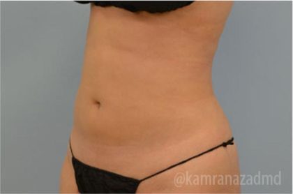 Liposuction Before & After Patient #2891