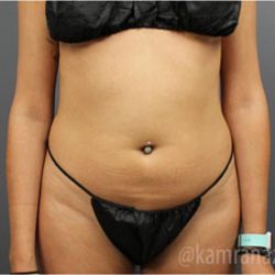 Liposuction Before & After Patient #2892