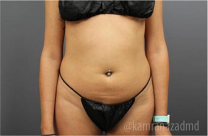 Liposuction Before & After Patient #2892